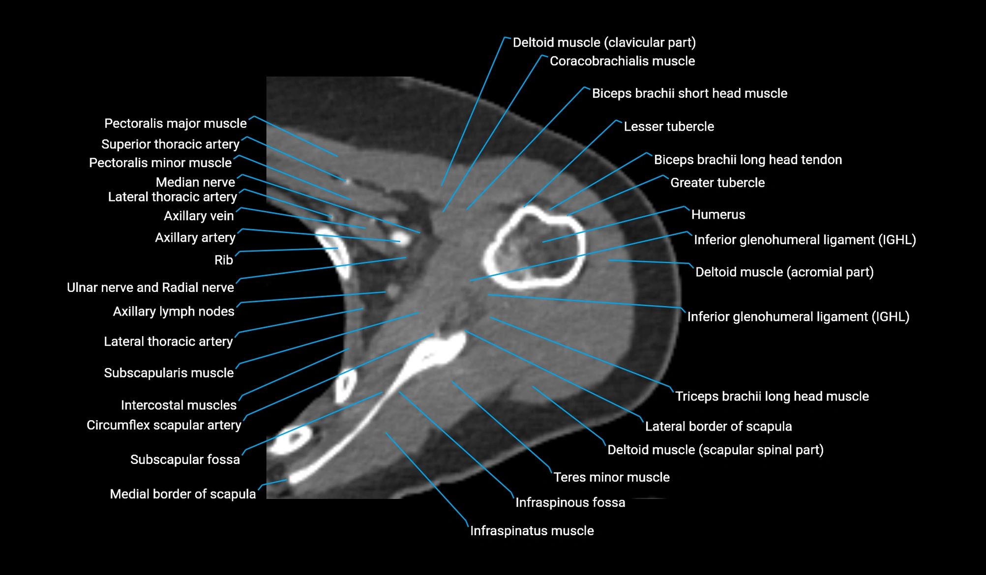 CT upper arm axial  cross sectional anatomy labelled radiology image -00112.webp